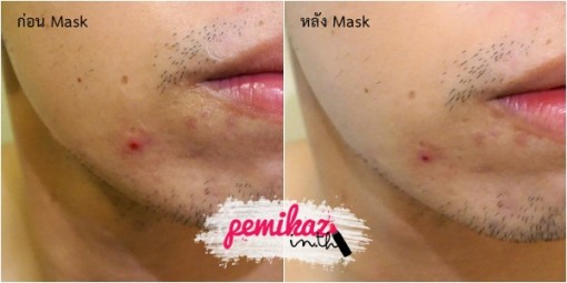 pemikaz-bkmask-acnemask-11