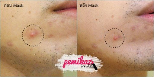 pemikaz-bkmask-acnemask-9