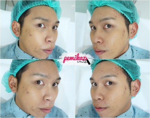 3-Pemikaz-Minerva Clinic - ก่อน หลัง ทำ หน้า