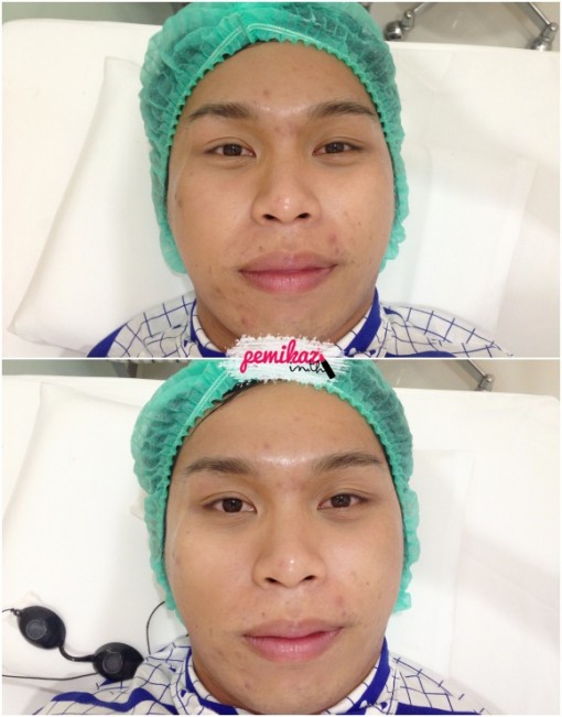 5-Pemikaz-Minerva Clinic  ก่อน หลัง ทำ หน้า